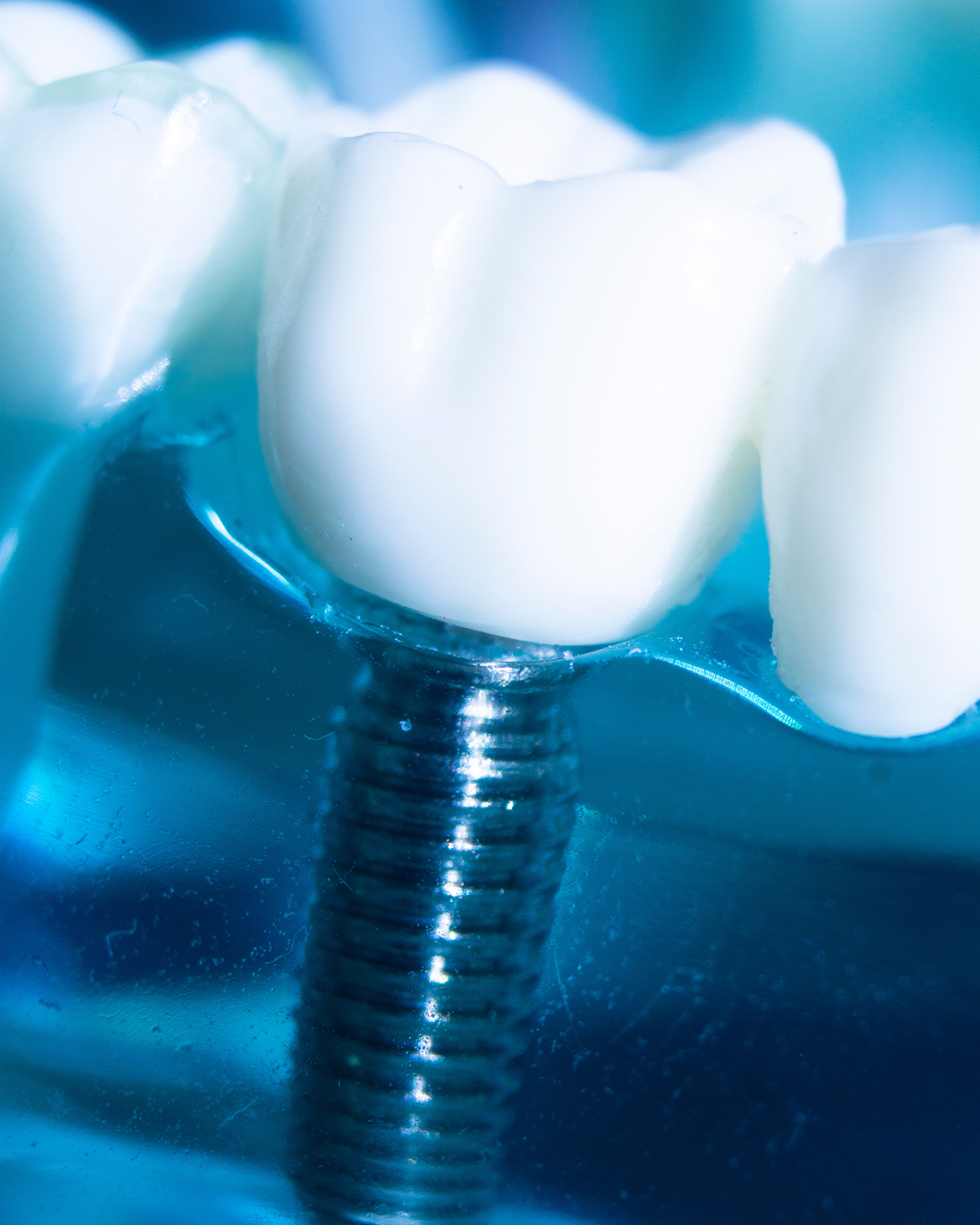 Dental Implants Procedure
